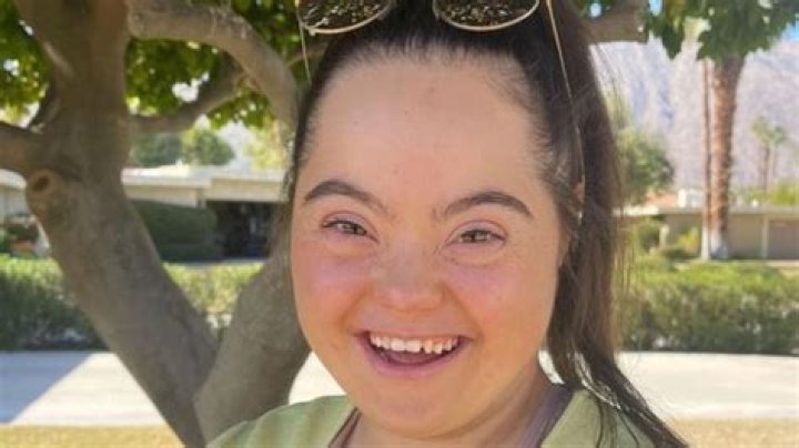 Inspiring Lives: Treacher Collins Syndrome Famous People