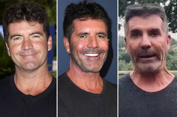 Simon Cowell's Transformation: A Look At His Before And After Plastic Surgery