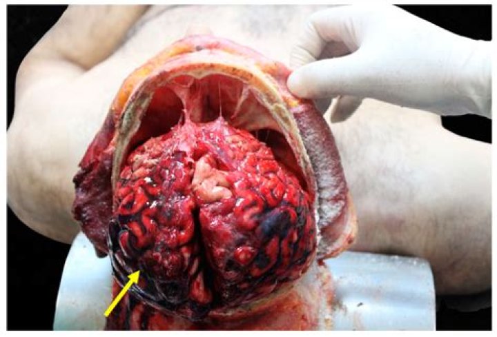 The Inside Scoop: Exploring The Enigmatic Anatomy Of Tarrare
