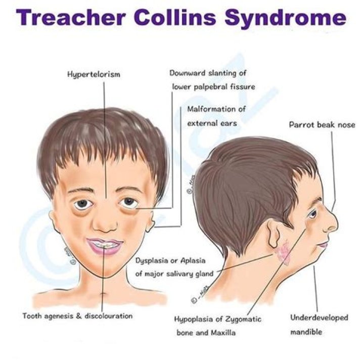 Uncovering The Extraordinary Lives Of Celebrities Living With Treacher Collins Syndrome