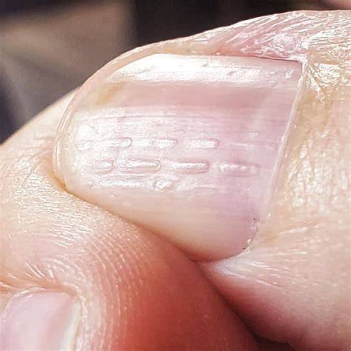Understanding Horizontal Ridges On Fingernails: What Do They Indicate?