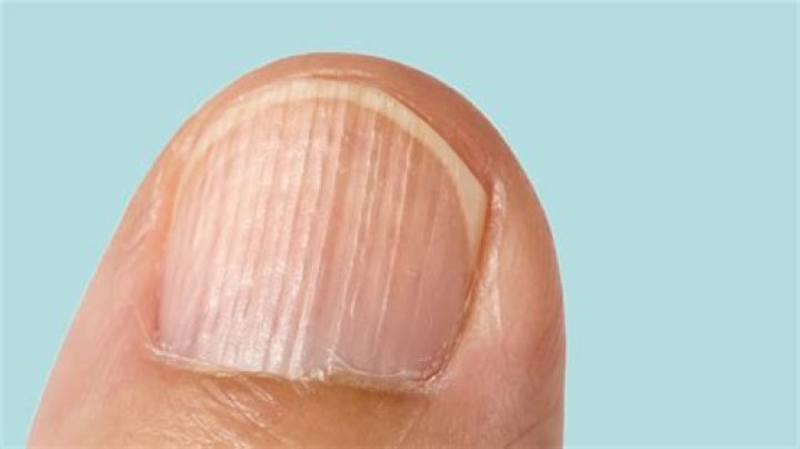 Understanding Horizontal Ridges On Toenails: What They Indicate About Your Health