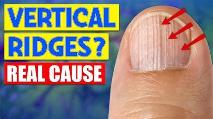 Understanding Nail Ridges Horizontal: Causes And Remedies