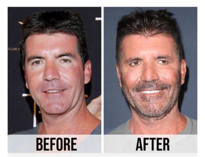 Unveiling Simon Cowell's Plastic Surgery Journey: A Transformation Tale