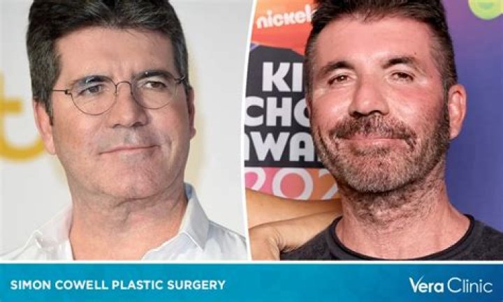 Unveiling Simon Cowell Before Plastic Surgery: A Journey Through Time