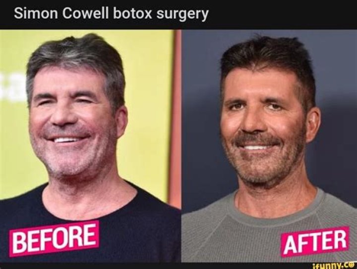 Unveiling The Hilarity Behind The Simon Cowell Botox Meme