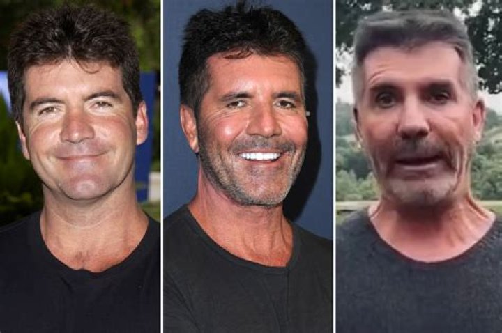 Unveiling The Mystery Behind Simon Cowell's Facelift
