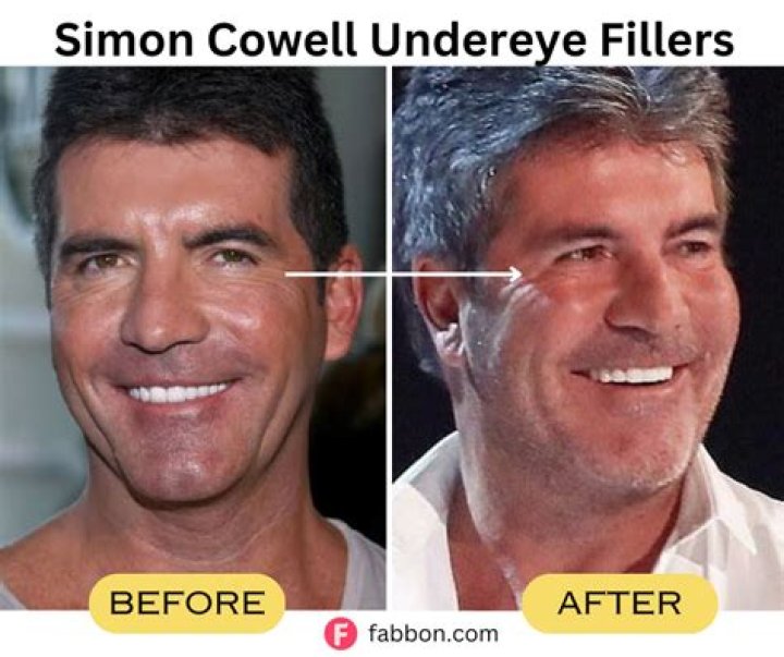 Unveiling The Mystery Behind Simon Cowell's Left Eye