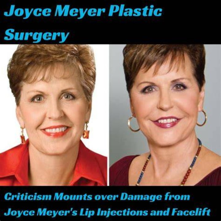 Unveiling The Truth Behind Joyce Meyer Face Surgery