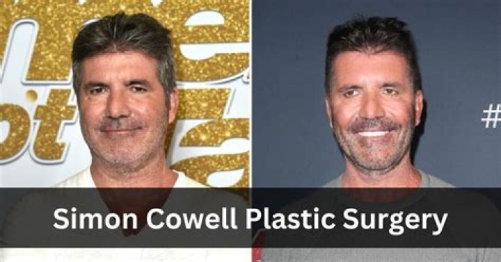 Unveiling The Truth Behind Simon Cowell's Plastic Surgery Journey